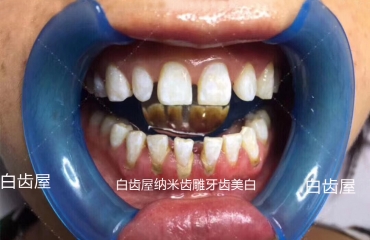 牙齿美白技术加盟_3